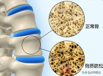 补钙就能预防骨质疏松吗，骨质疏松吃钙片可以缓解吗还要吃一些什么