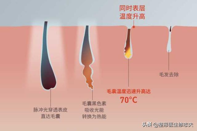 女生嘴边长小胡子应该怎么办？