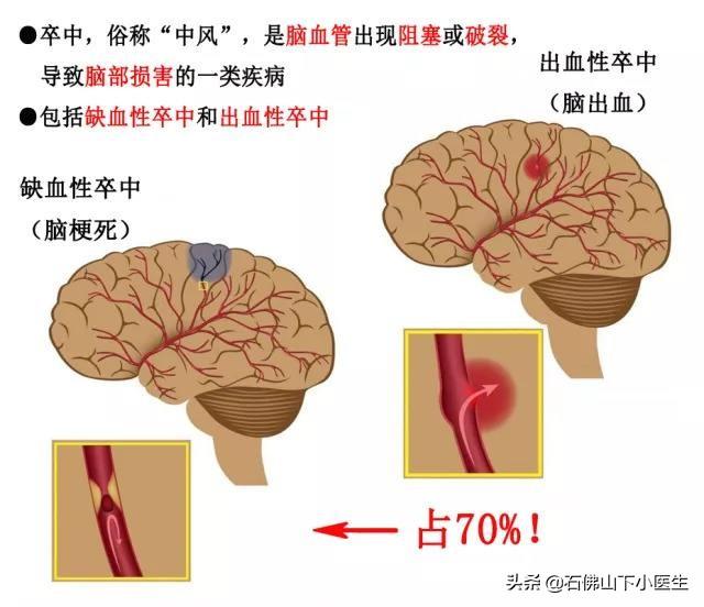 头条问答 得了脑中风后 吃什么食物才能恢复的快 吃什么食物才能预防复发 22个回答