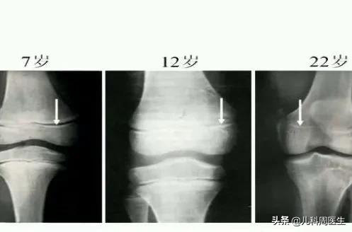 生长激素行业藏着什么秘密，孩子打生长激素真能长高吗？