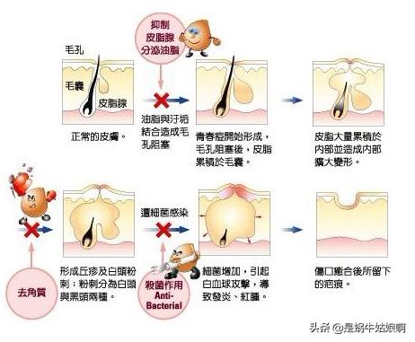 如何除痘坑(如何除痘坑的方法)