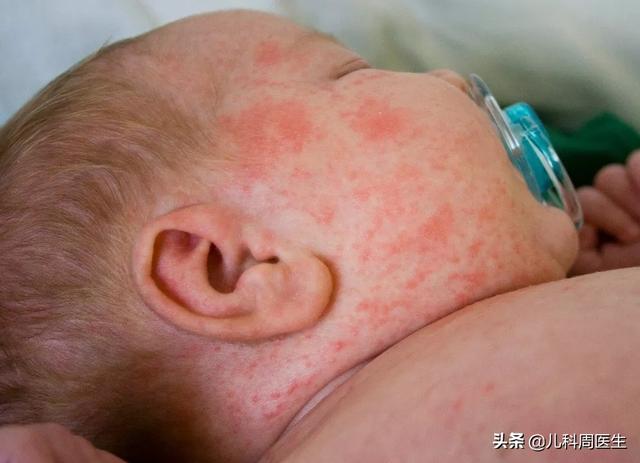 夏季皮炎还是痱子，宝宝经常起热痱子，是缺什么东西吗？