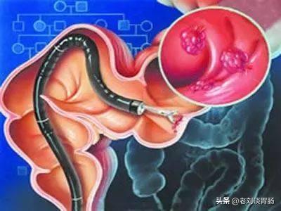 肠癌早期检测一定要去做肠镜吗？害怕又预约不到，不想去做？