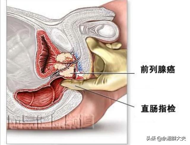 药物去势:药物去势是什么意思 前列癌内分泌治疗多久复查？