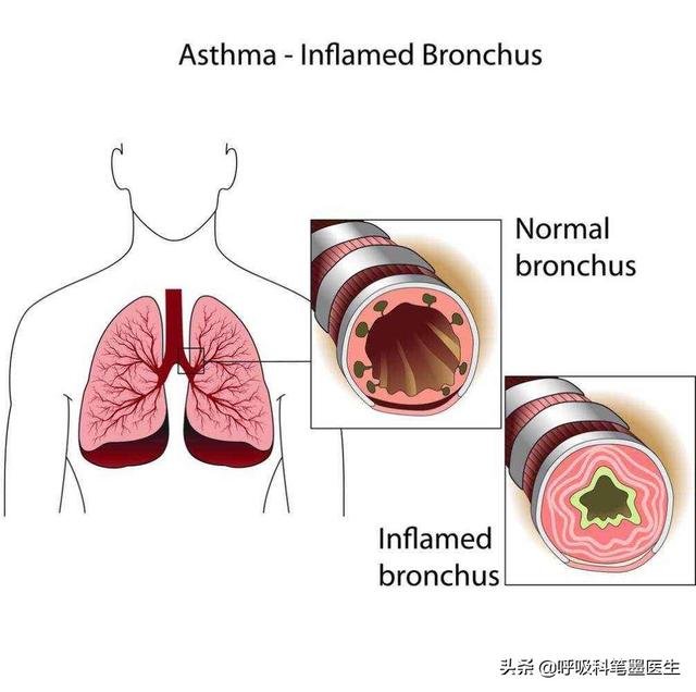 哮喘性支气管肺炎严重吗:哮喘性支气管肺炎严重吗? 支气管肺炎和肺炎哪个更严重？