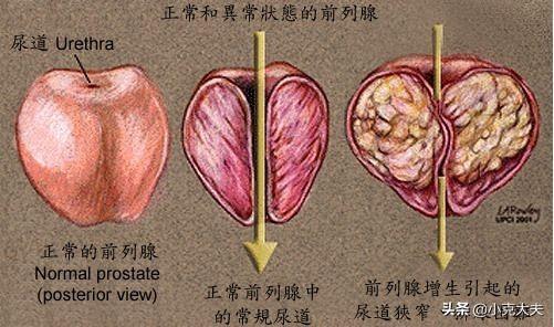 男性按摩壮阳图片，关于前列腺，男性有哪些需要知道的？男性如何保养前列腺？