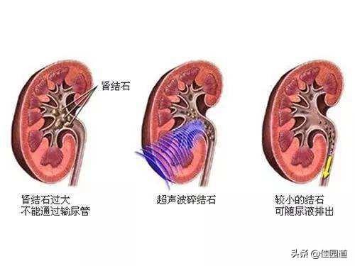 肾结石疼痛怎么办(肾结石特别疼怎么办最简单的方法)