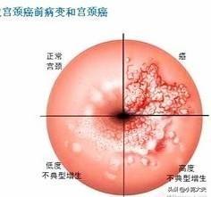 宫颈癌a2型特征;宫颈癌a2型特征