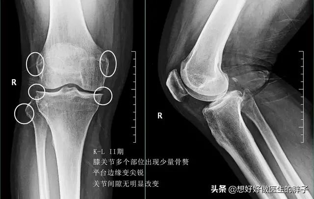 骨软骨病x线特征:骨软骨瘤x线表现是什么 骨癌的X线检查有什么表现？