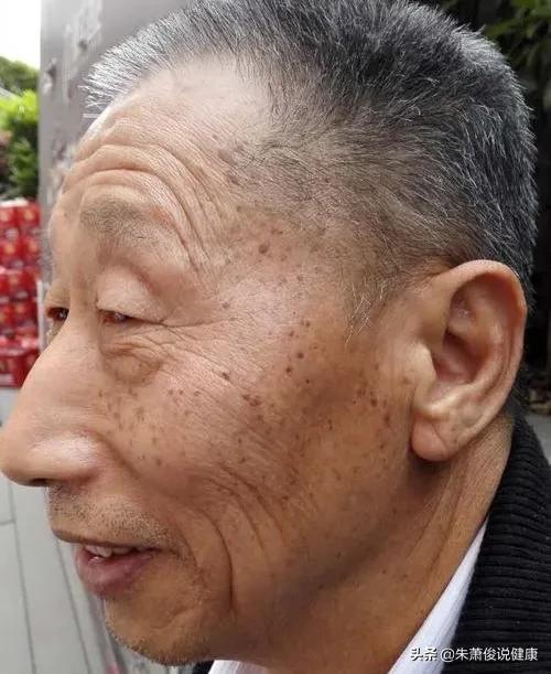 四十岁的人脸上开始长老年斑,该怎么办?-生活百科