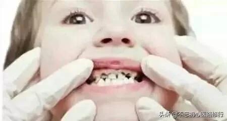 轻度四环素牙是什么颜色:四环素牙涂什么颜色的口红 什么是牙齿美白，什么样的牙齿适合美白？