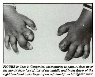 头条问答 - 如果人没有了痛觉,是不是可以解决好多