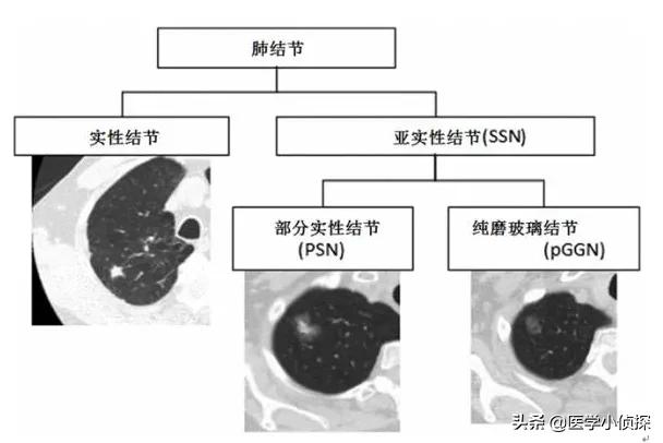 养生堂代茶饮方治疗肺部结节,肺结节喝什么水好能散结？