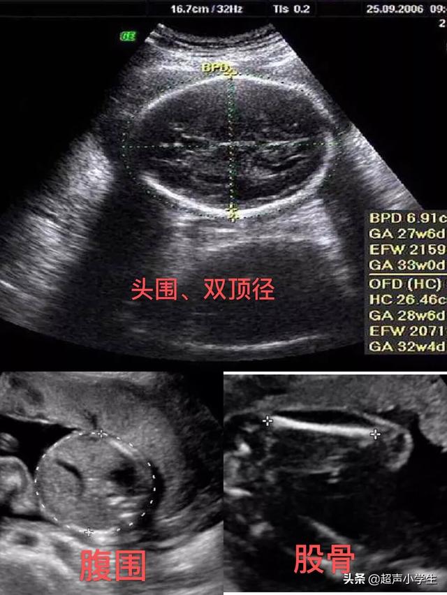 头条问答 34周怀孕八个半月 为什么医学上有36周了 超声小学生的回答 0赞