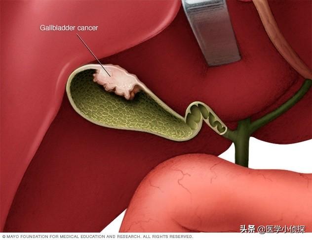 三大抗癌石,胆囊息肉、胆结石会转化为胆囊癌吗？