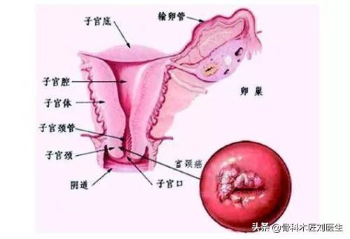 宫颈癌发出的第一个信号:宫颈癌需要关注哪些信号？