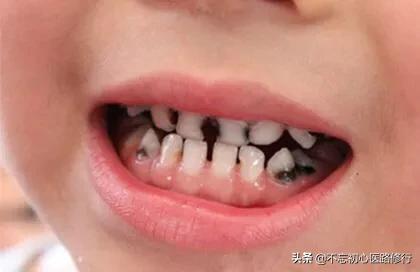 轻度四环素牙是什么颜色:四环素牙涂什么颜色的口红 什么是牙齿美白，什么样的牙齿适合美白？