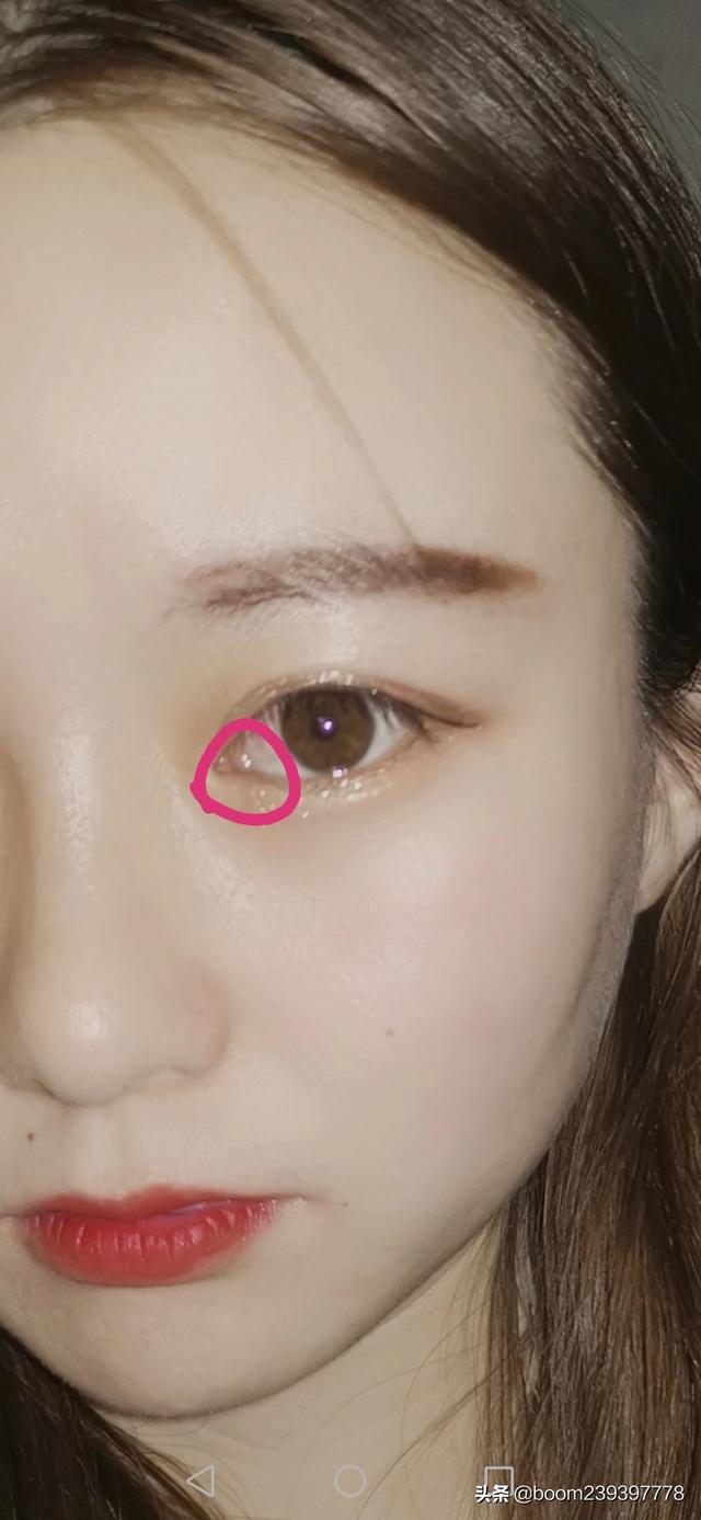 头条问答 - 眼角长肉是怎么回事?(1个回答)