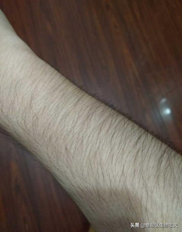 头条问答 女孩子胳膊上的汗毛又密又长怎么办 整形医生修志夫的回答 0赞