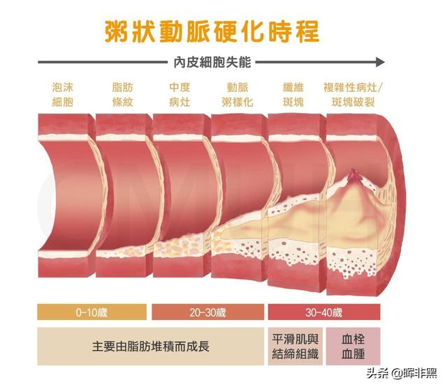 什么是四招一试，血管硬化不是小事，把血管变软，4个方法值得一试，是哪4个方法