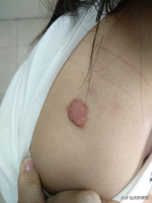 头条问答 手术后伤口愈合了 但是疤痕越来越大 是怎么回事 皮肤美莹的回答 0赞