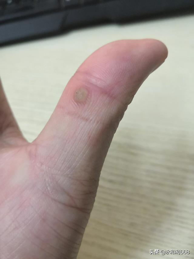 头条问答 - 胳膊弯有刺猴是怎么回事?(5个回答)