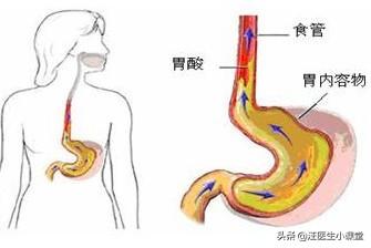 千草堂螺旋藻精片能保护肠胃吗:胃发酸，喉咙有异物感，口里发热，还口干口苦，是怎么回事？