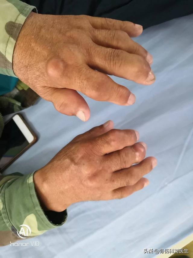 头条问答 - 手指脚趾关节肿胀疼痛,风湿三项检查也正常是什么原因?