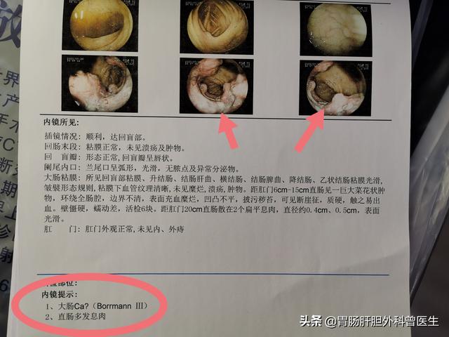 瘫痪老人肠梗阻怎么办:瘫痪病人肠梗阻怎么办 肠癌把肠子全堵了怎么办？