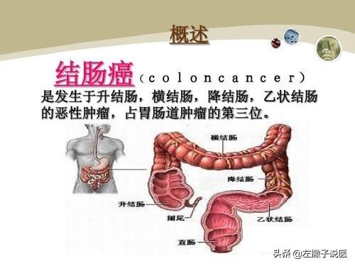 非感染性腹泻可见于:能不能从大便上判断出一个人是否患有结肠癌？