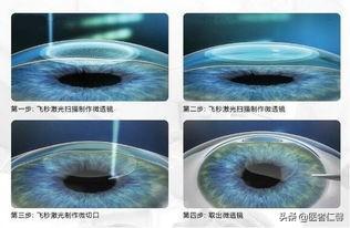 激光脱毛6年后后悔了:激光脱毛6年后后悔了肤色不白能用激光脱毛吗 激光脱毛能保持多久的效果？
