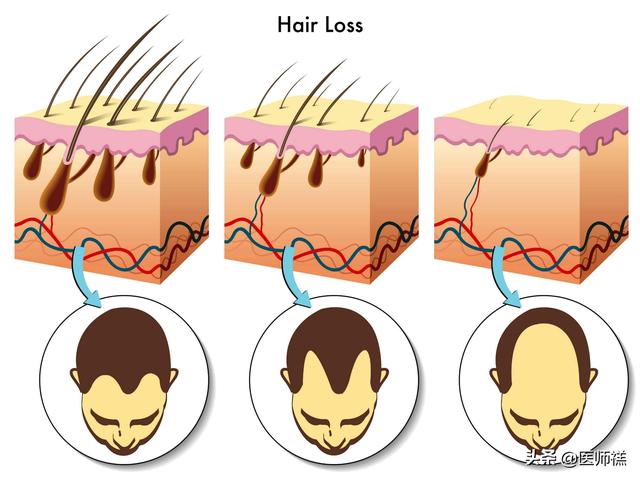 补肾能长头发吗，男人肾虚会导致脱发吗有何依据