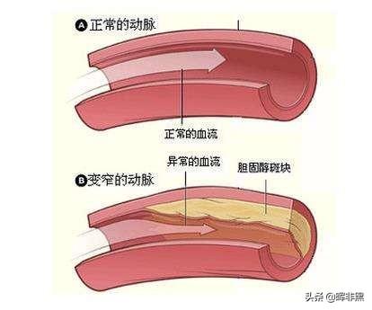 什么是四招一试，血管硬化不是小事，把血管变软，4个方法值得一试，是哪4个方法