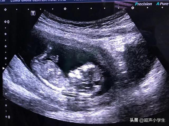 头条问答 去年7月份怀孕 到今年3月份生了 正常吗 306个回答