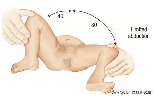 髋关节脱位:父母如何及早发现宝宝髋关节是否有脱位现象？