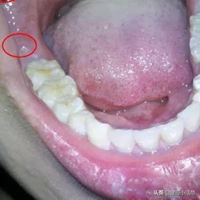 一开始我并不知道是智齿发炎,以为是普通的牙炎,引起的嘴肿腮胀,毕竟