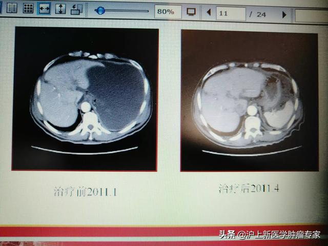 头条问答 恶性肿瘤造成腹腔积水是不是就没有治了 沪上新医学肿瘤专家的回答 0赞