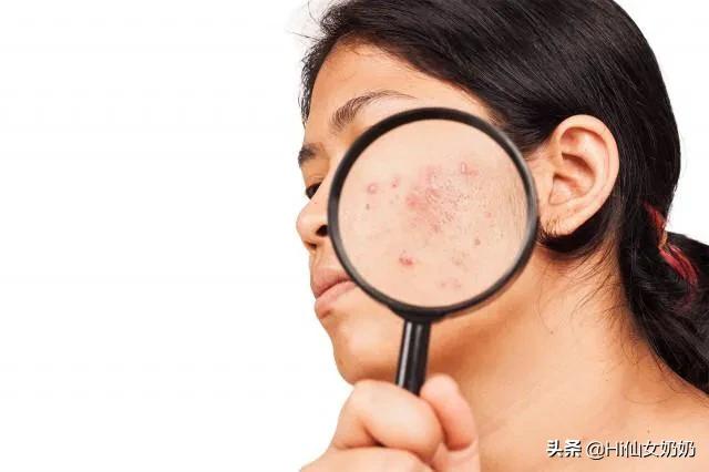 脸部有螨虫是什么症状:脸上螨虫的危害到底有多大？
