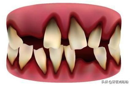 不拔掉牙根,能镶满口活动假牙吗？请教？