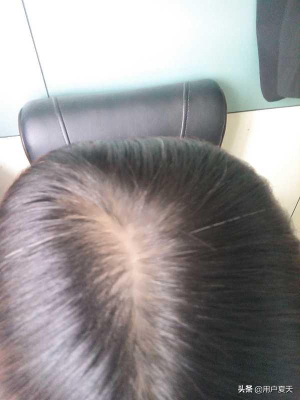 年轻人脱发原因(年轻人脱发原因脂溢性脱发怎么办)