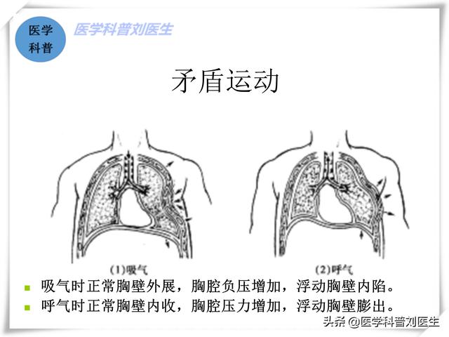 肋骨骨裂的症状:第五、六根肋骨骨折了，需要如何休养才能好的比较快？