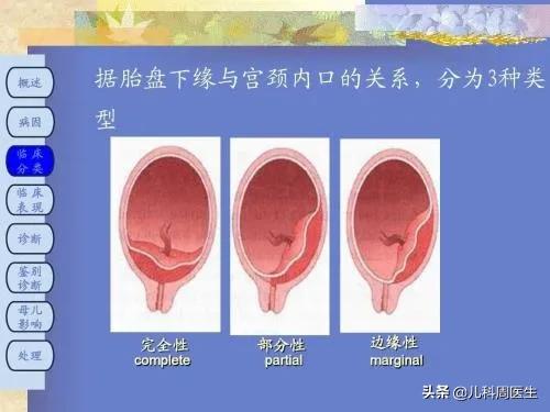 头条问答 前置胎盘很危险吗 孕妇出现前置胎盘该怎么办 儿科恩铭的回答 0赞