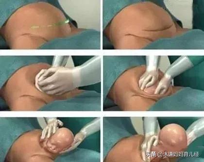 剖腹产后如何尽快恢复元气(二胎剖腹产后