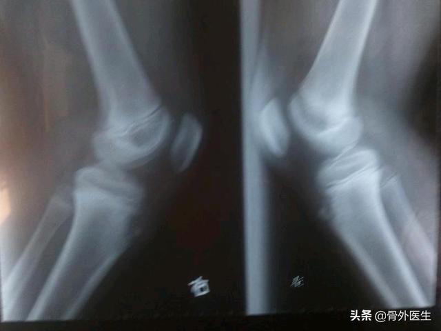 胫骨结节骨软骨病治疗:膝盖下面疼痛半年多了，摸着有个包，很硬，是不是长什么了？