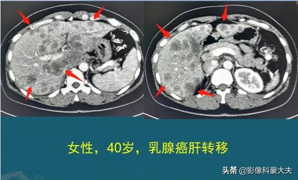 化疗什么情况下用红药水:化疗用的红药水叫什么 癌症化疗时出血，是肿瘤恶化了吗？