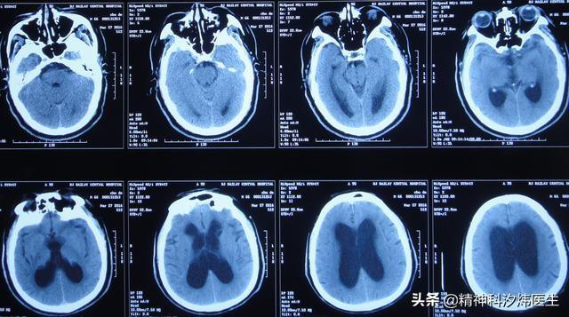 精神分裂症的原因,哪些人容易得精神分裂症？