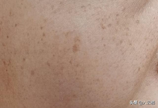雀斑黄褐斑:怎样快速去除黄褐斑和雀斑？
