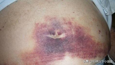 慢性胰腺炎症状:胰腺炎犯病了禁食了一天，还要去医院吗？