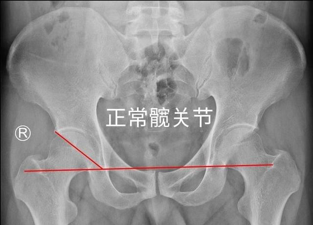 头条问答 - 股骨头脱出如何治疗?(1个回答)