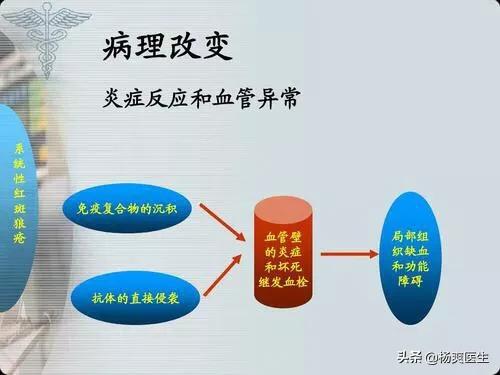 系统性红斑狼疮症状:什么是系统性红斑狼疮性肾炎？